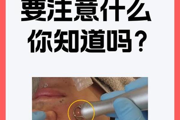 韩国相师点痣视频播放全集、激光点痣视频手法视频教学