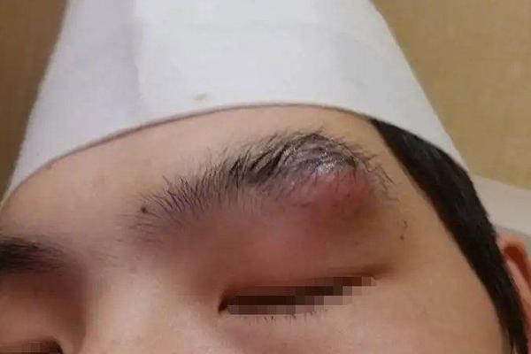 眉毛上一颗痣相小肉瘤—眉毛上长了个肉瘤