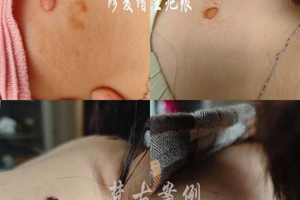 瘢痕痣相,疤会不会变成痣