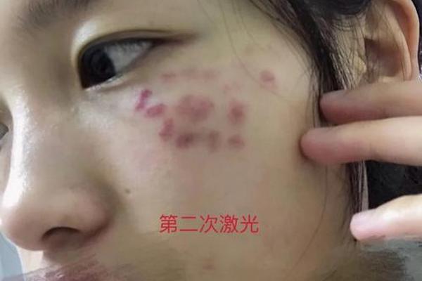 青岛看痣相-青岛市立医院切痣