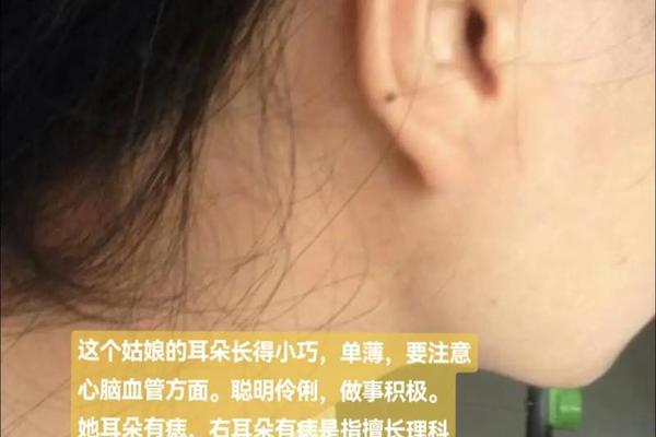 耳朵相痣玄学图解女人—耳朵哪里的痣有福气图