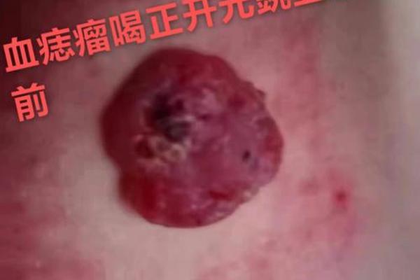 红痣长在前胸是吉相吗—胸前长红色痣代表什么