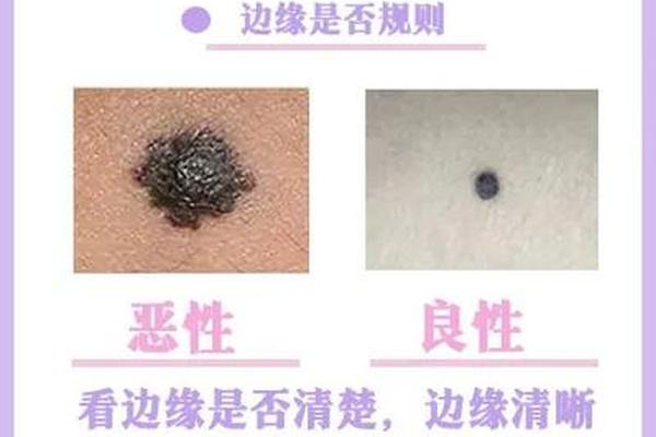 痣相厄—凶痣的种类及区别