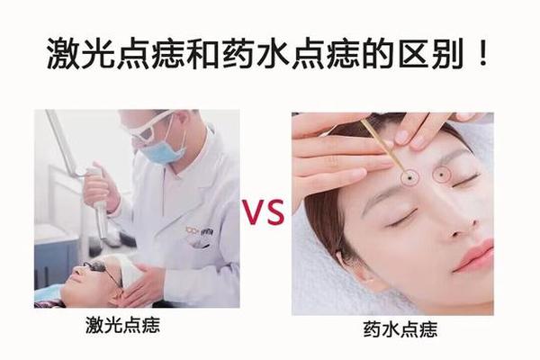 相城中医医院可以点痣不 中医点痣好还是激光好