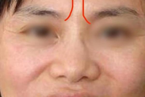 八字法令纹 八字法令纹