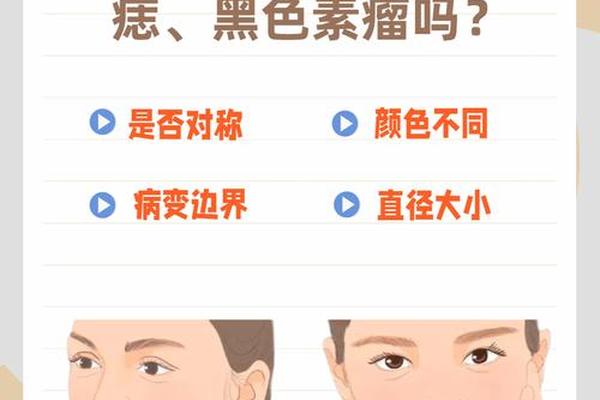 痣相垃圾 良痣与恶痣的区别