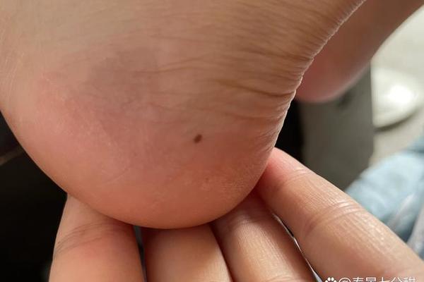 脚踝下面的痣相_左脚踝下方有痣代表什么