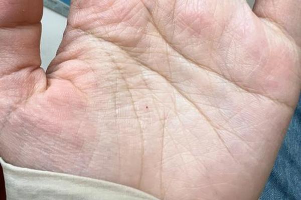 手掌长了个相痣红点 手掌上有红痣代表什么
