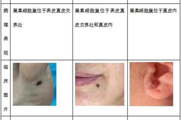 皮内痣痣相-表皮痣和皮内痣区别 皮内痣痣相-表皮痣和皮内痣区别