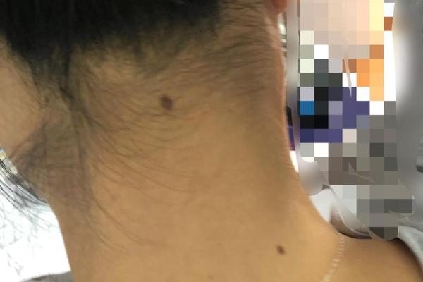 痣相 脖子后面_脖子有痣代表什么