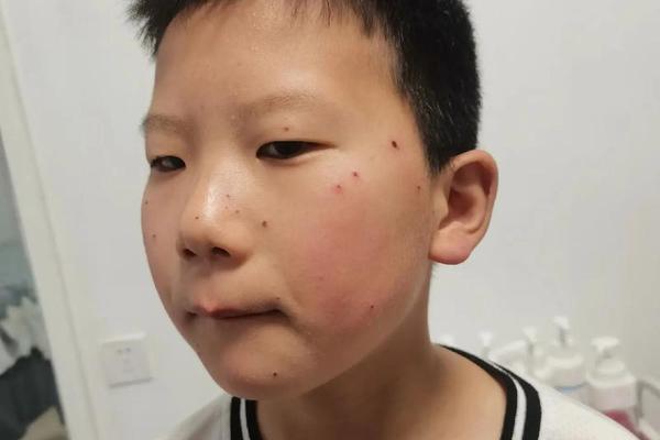 孩子面部痣相最准图_儿童痣图片大全 孩子面部痣相最准图_儿童痣图片大全