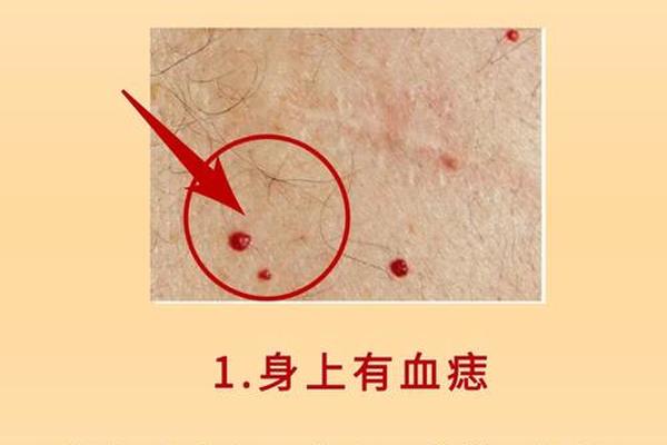 血痣的相法-法相与本相 血痣的相法-法相与本相
