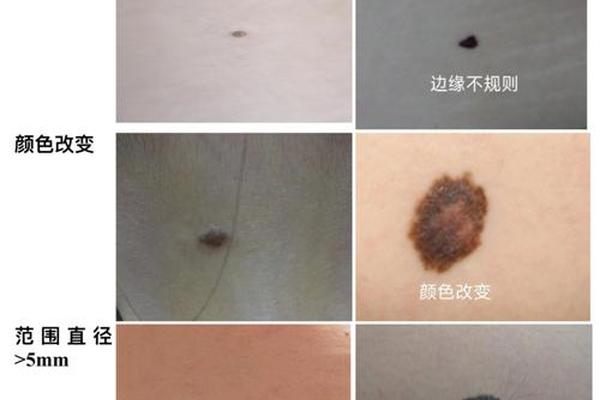 背痣与肾相的区别—为什么肾的部位长了颗痣