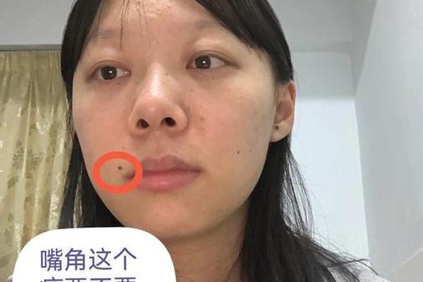 嘴角痣能点掉吗痣相_嘴角的痣可以去除吗有什么讲究嘛