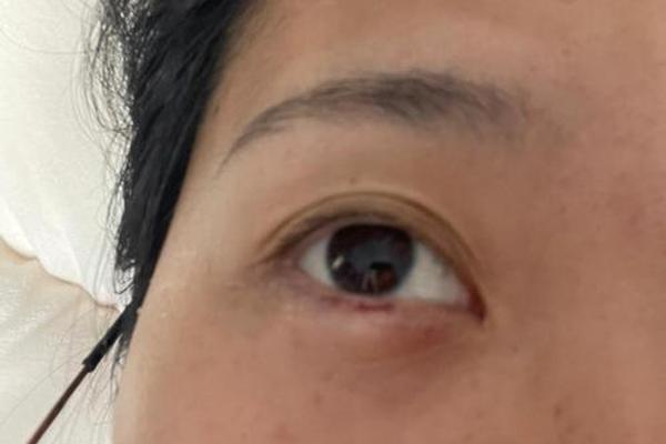 下眼皮发红痣相、下眼皮长红痣好不好 下眼皮发红痣相、下眼皮长红痣好不好