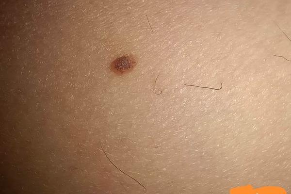 左大腿内侧黑点的痣相_左大腿外侧有痣图解 左大腿内侧黑点的痣相_左大腿外侧有痣图解