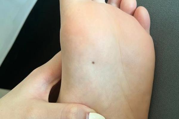 麻衣神相脚痣_小脚那些部位有痣不好