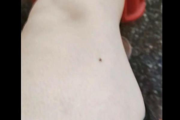 女孩腿部痣相;小腿有痣代表什么意思