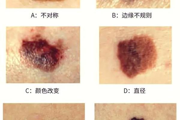 黑痣与红痣相法一样吗 黑痣与红痣的区别