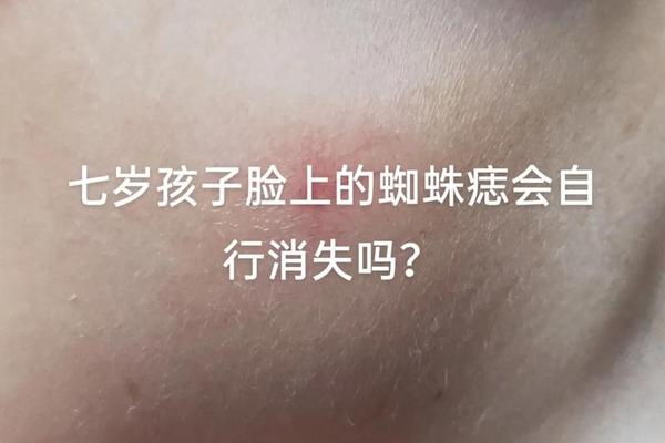 痣自己消失了相由心生-痣会自己消失吗