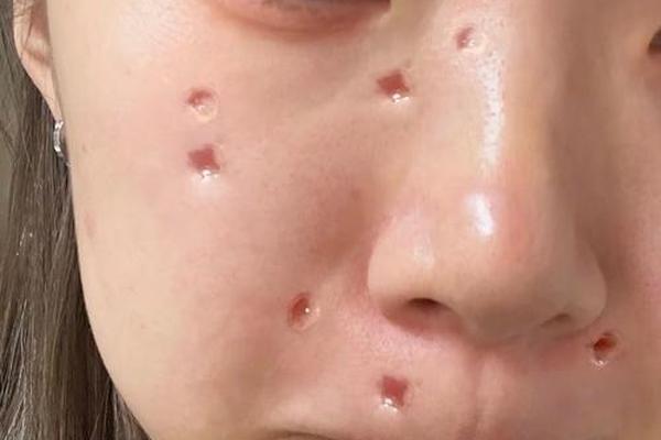 人相点痣图片,点痣一个星期后的图片