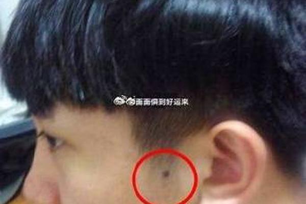 右侧头发中有痣的痣相;鬓角有痣图解