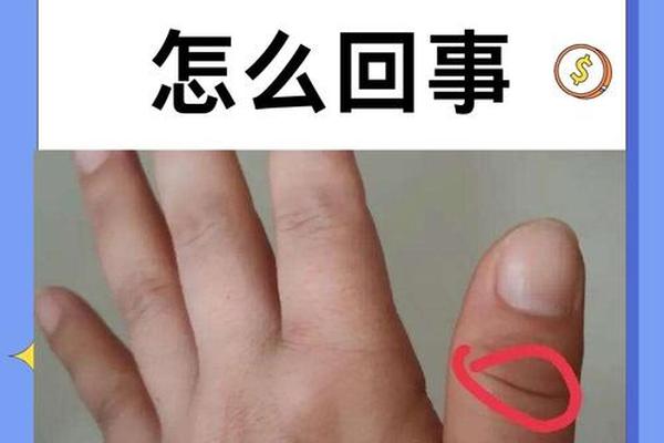 拇指关节上的痣相 拇指上有几个关节 拇指关节上的痣相 拇指上有几个关节
