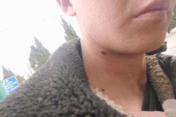 脖子左颈部痣相;脖子左侧有痣的男人