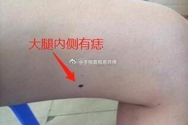 大腿内外侧痣相—大腿上长痣相图解大全 大腿内外侧痣相—大腿上长痣相图解大全