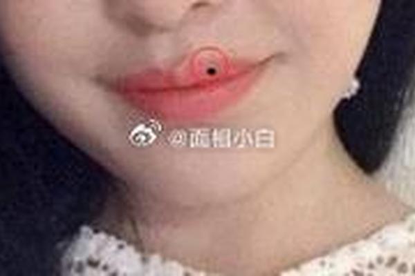 上唇唇沟有痣的女人的相;上唇有痣图片
