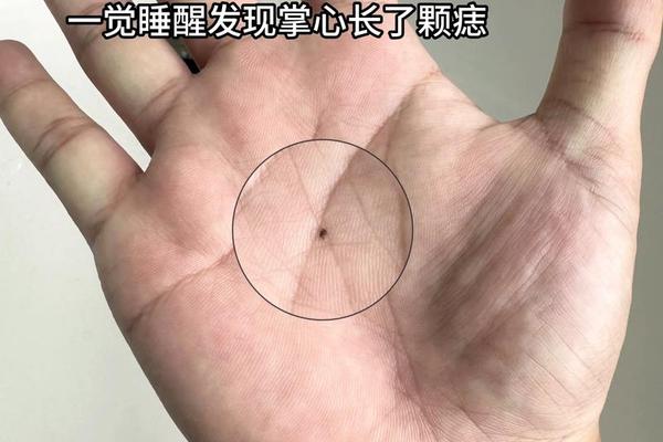 痣相改变面相怎么看图解(手掌痣相图解)