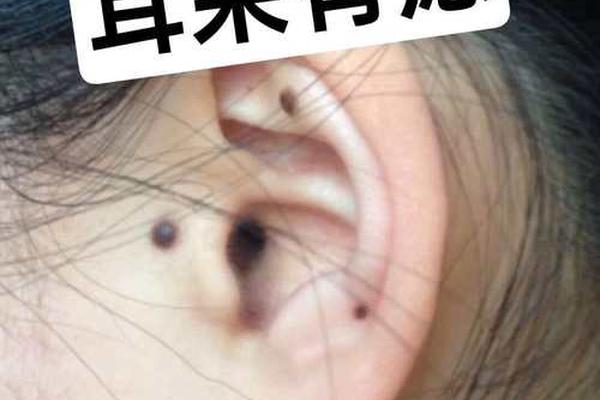 耳痣图相女生图片高清—女生耳朵痣的详解图