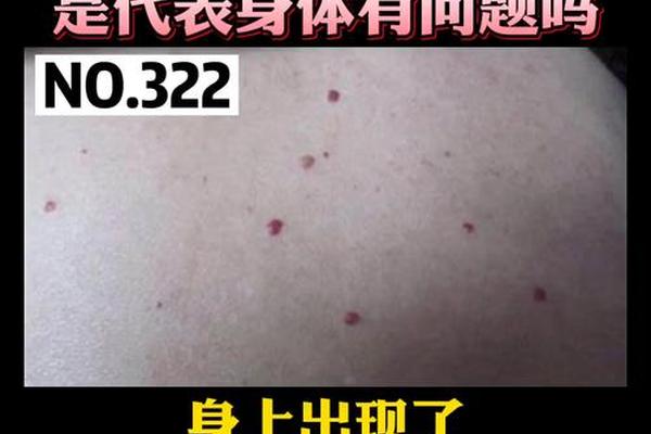 痣相黑字和红字 黑痣变红了有什么预兆 痣相黑字和红字 黑痣变红了有什么预兆