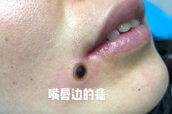 男下唇痣相-嘴唇下有痣的男人面相