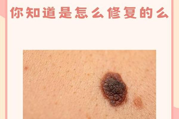 痣相 裂纹-黑痣上有裂纹怎么回事
