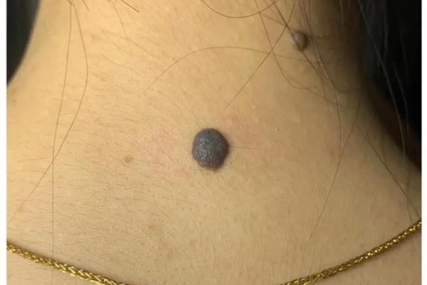 脖子肩膀痣相 肩膀靠近脖子地方有痣