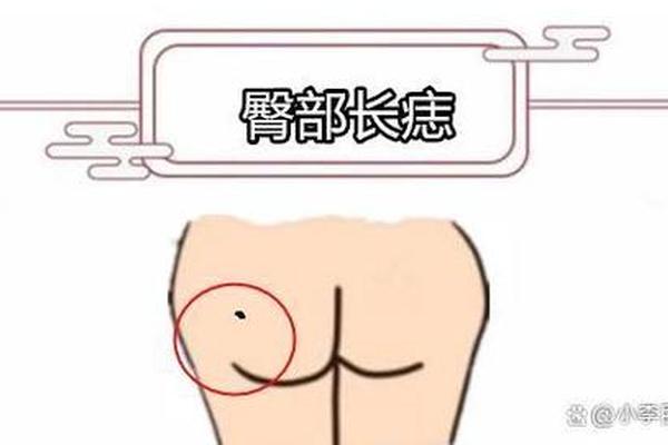 肤股沟有痣相如何-腹股沟长痣是吉还是凶