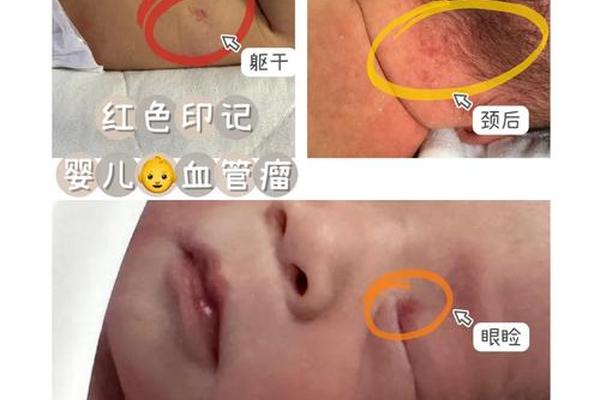 血管痣与痣相_长血管痣说明什么