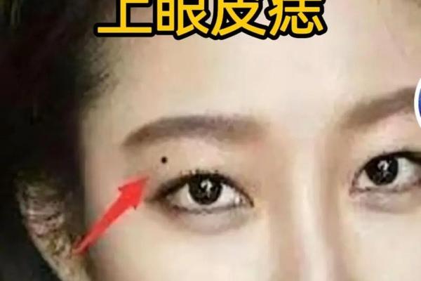 双眼皮红痣痣相 眼皮长红痣有什么说法