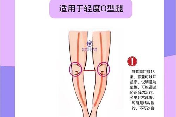 外八字怎么矫正