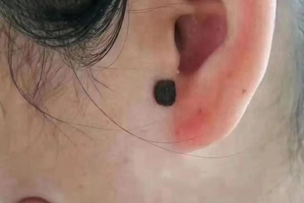痣相腹部有痣,耳朵上有痣
