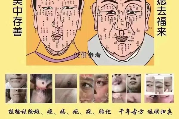 脸上祛痣相、脸上去痣图片