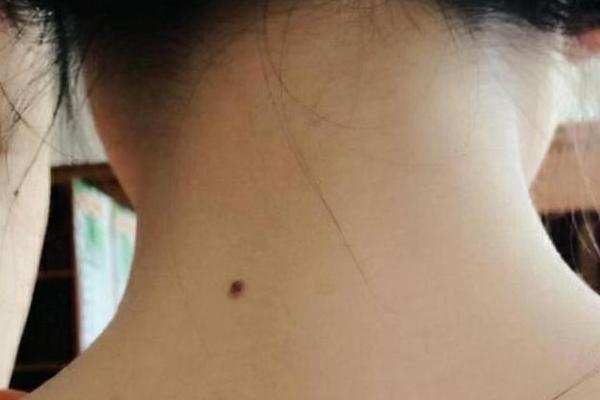 体相脖子上有痣艺术_脖子上长痣的人