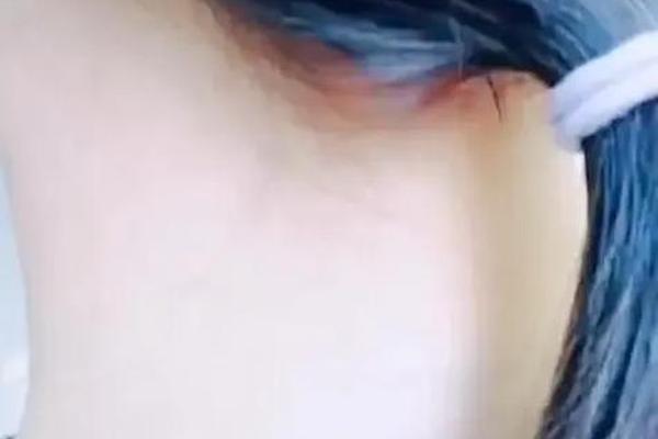 痣相女脖子背后有痣_后脖子有痣的女人代表什么意思