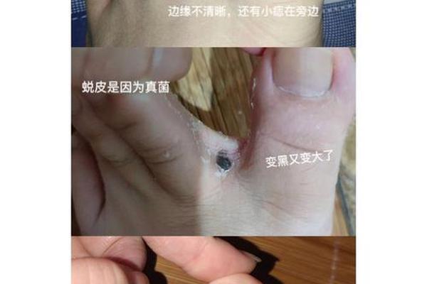 脚趾缝长痣的相(脚趾缝间长痣代表什么意思)