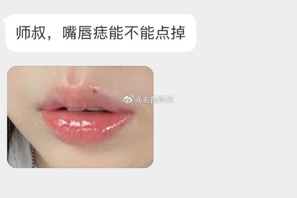 开运痣相 上唇 痣在上嘴唇上是什么痣