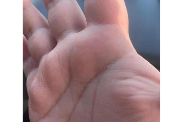 手心有红痣是帝王之相吗(掌心红痣代表什么意思)