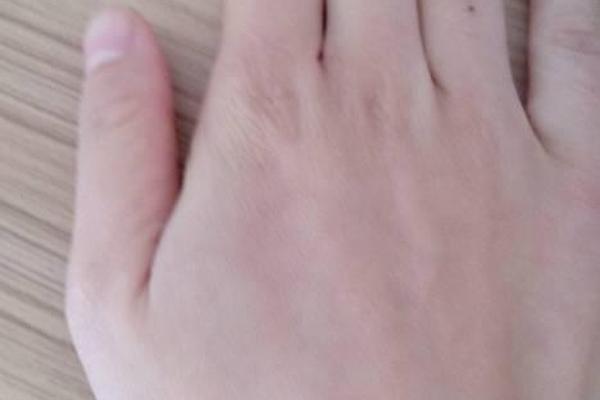 右手痣相无名指-右手无名指长了一个痣