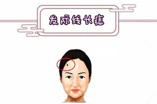 痣相发际线有痣—右边发际线边缘有痣