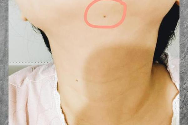 观相下巴长痣好吗女人—下巴最底部有痣的女人